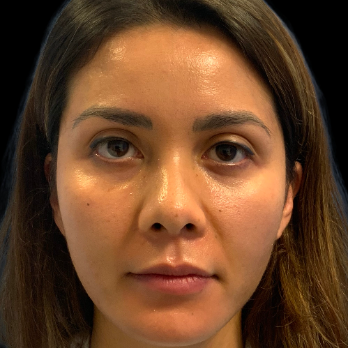 ethnic-rhinoplasty-before